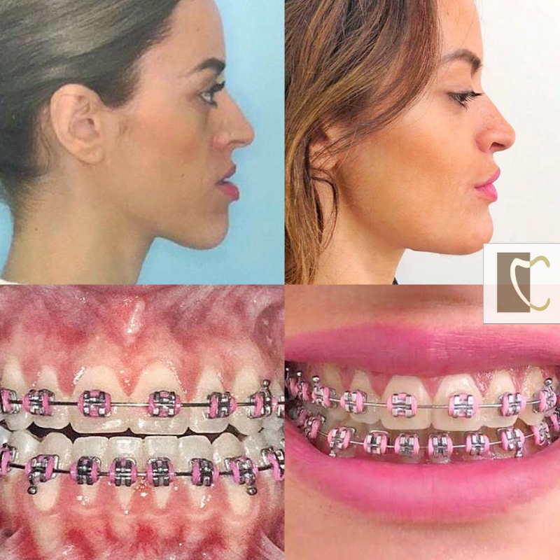 Excesso mandibular - Deficiência maxilar - Classe III - Dra