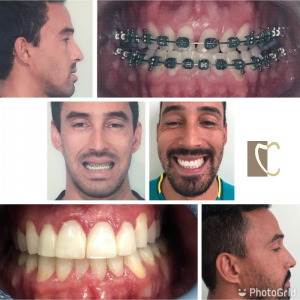 Exemplos de Cirurgias Ortognáticas realizadas pelo Prof. Dr. Francisco Pacca e equipe