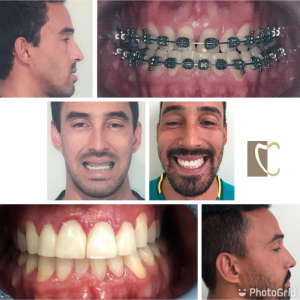 1 pçs dental baixo maxilar mandíbula tecido mandíbula anatômico